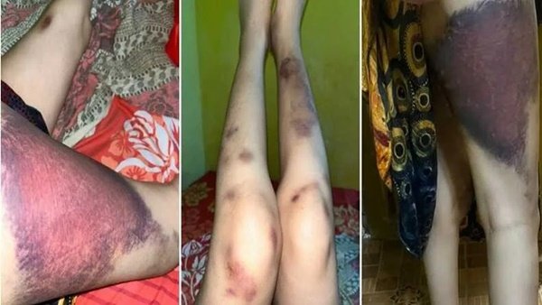 Tangkapan layar kondisi kaki Selvy yang mengalami lebam serius, diduga akibat penganiayaan suaminya. (Foto kolase)
