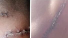 Luka yang kena benda Tajam, Leher dan Pinggul