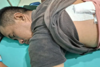 Kondisi Rahmat Saputra (36), pedagang korban pembacokan di Percut Sei Tuan, saat menjalani perawatan medis. Tampak perban menutup luka jahitan di bagian punggungnya.